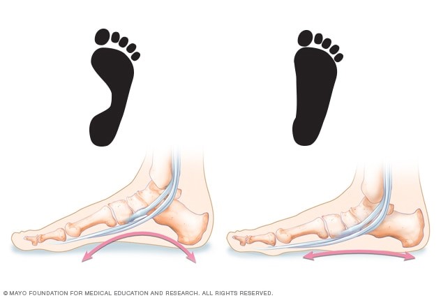 Illustration comparing normal and flatfeet footprints 
